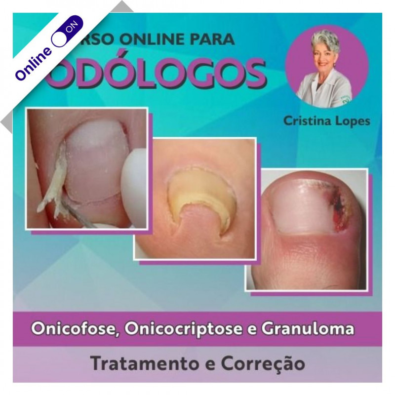 Curso Online de Onicofose, Onicocriptose e Granuloma  - Tratamento e Correção 