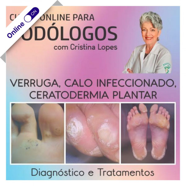 Curso de Podologia Online - Verruga Plantar, Calo Infeccionado e Certodermia Plantar